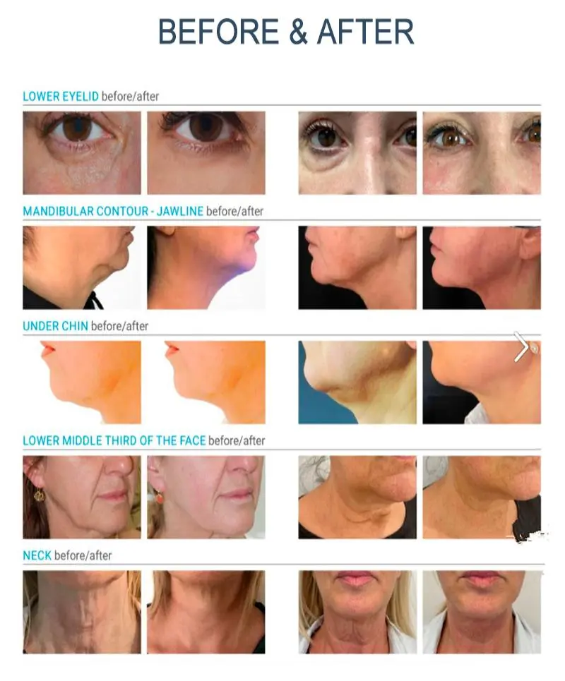 portable liposuction machine for sale   portable liposuction machine for sale