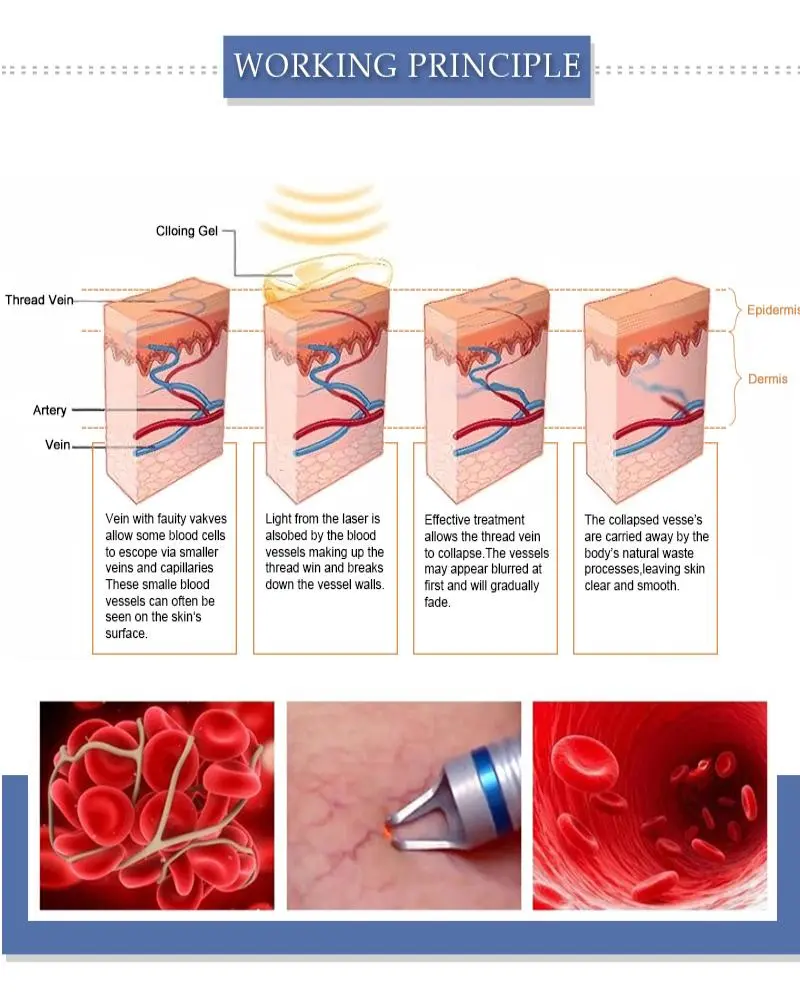 980 nm diode laser spider vein removal machine made in China 980 nm diode laser spider vein removal machine made in China