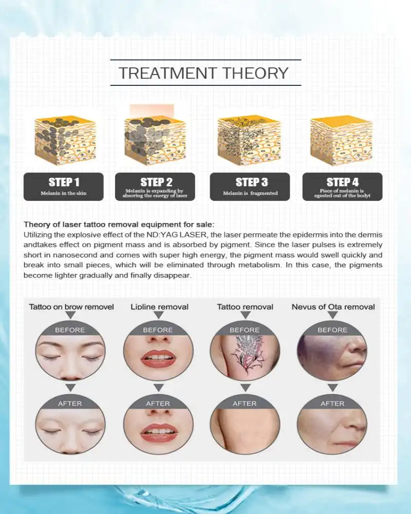 fàbrica de màquines per eliminar tatuatges amb làser fàbrica de màquines per eliminar tatuatges amb làser