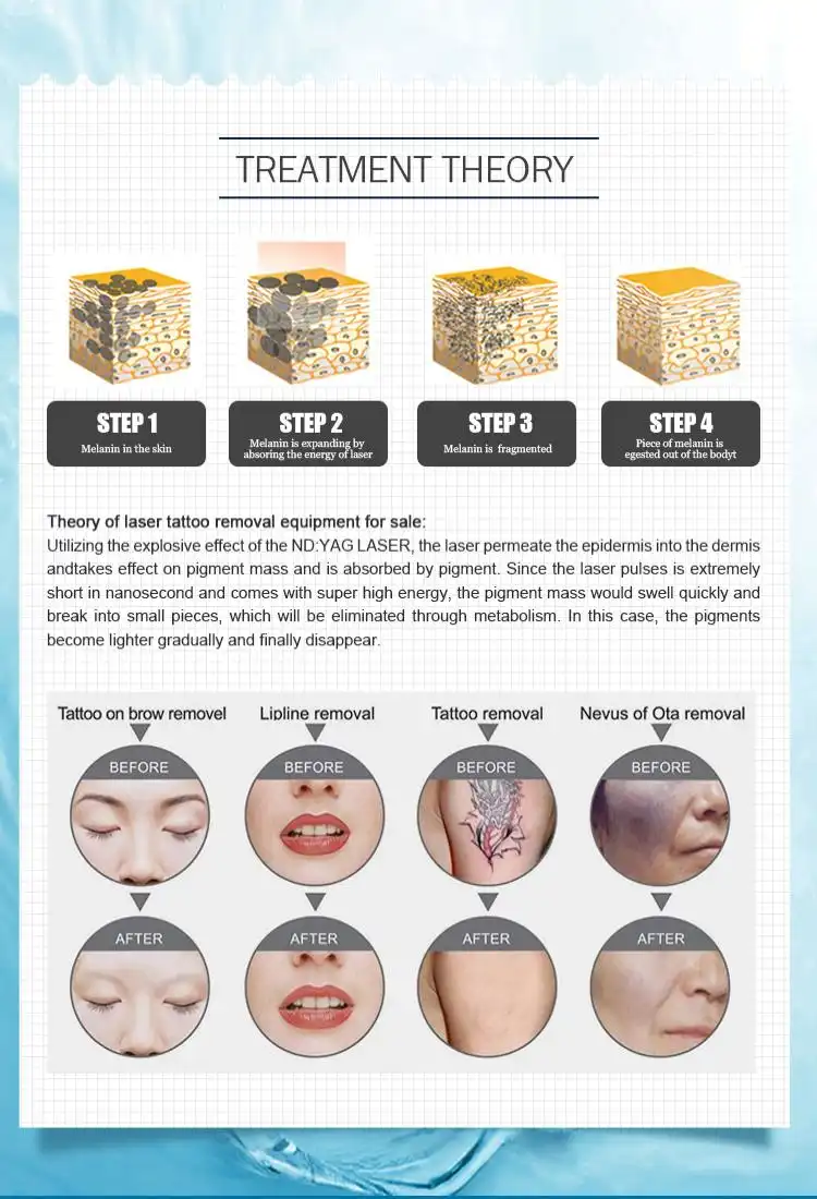 portable q switch yag laser made in China portable q switch yag laser made in China