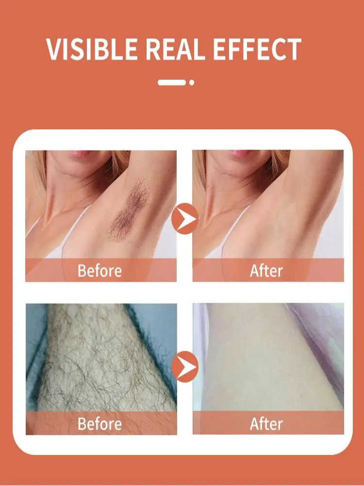 china painless at home laser hair removal manufacturers china painless at home laser hair removal manufacturers