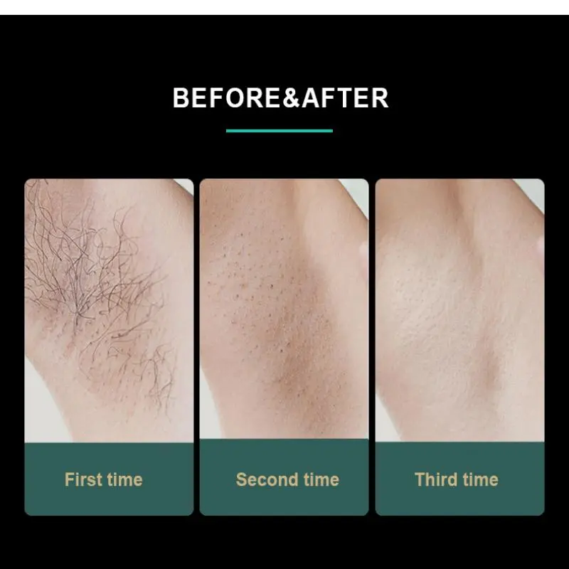 china medical laser hair removal machine factory china medical laser hair removal machine factory