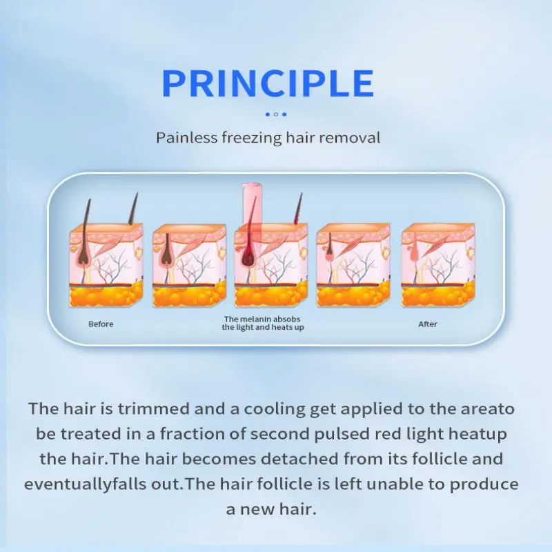 808 nm laser hair removal factory 808 nm laser hair removal factory
