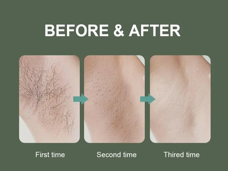 china professional laser hair removal machine factory china professional laser hair removal machine factory