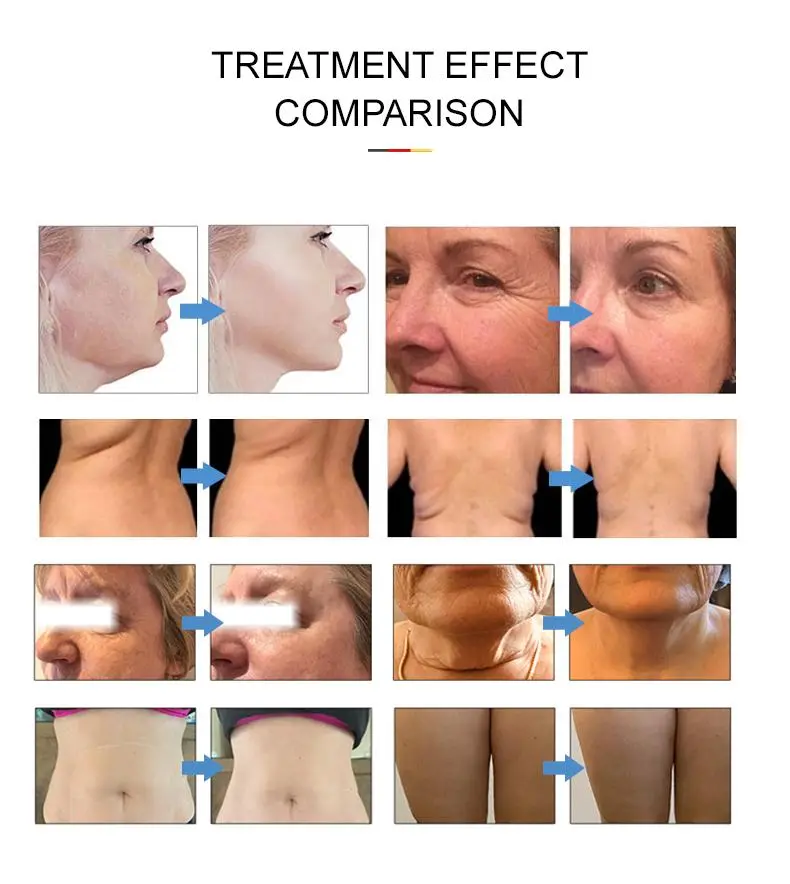wholesale hifu skin tightening machine wholesale hifu skin tightening machine
