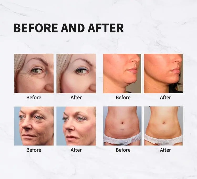 china hifu vaginal machine manufacturers china hifu vaginal machine manufacturers