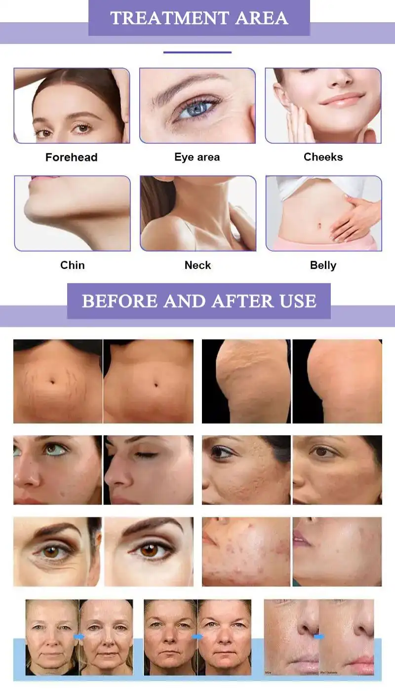 china morpheus 8 machine manufacturers china morpheus 8 machine manufacturers