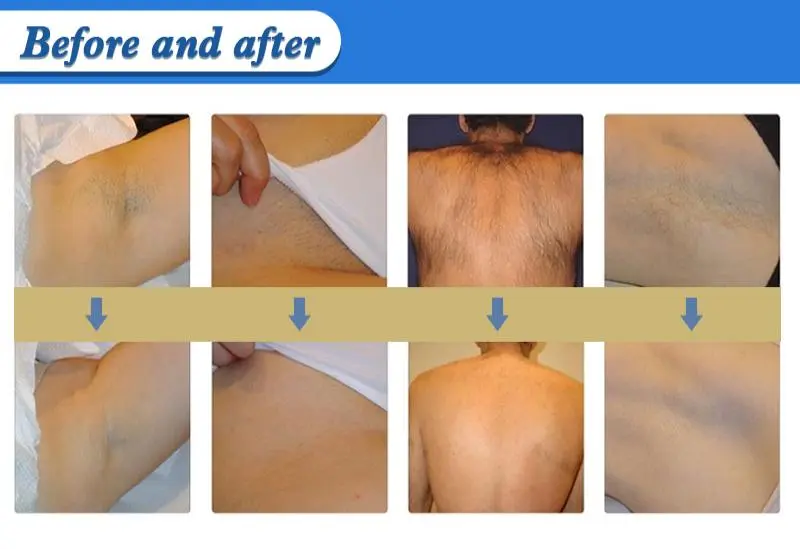 SHR hair removal machine for sale   SHR hair removal machine for sale