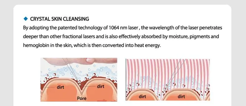 1064 nd yag laser hair removal for sale 1064 nd yag laser hair removal for sale