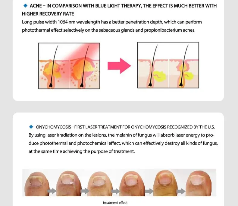 china 1064 nd yag laser hair removal for sale china 1064 nd yag laser hair removal for sale