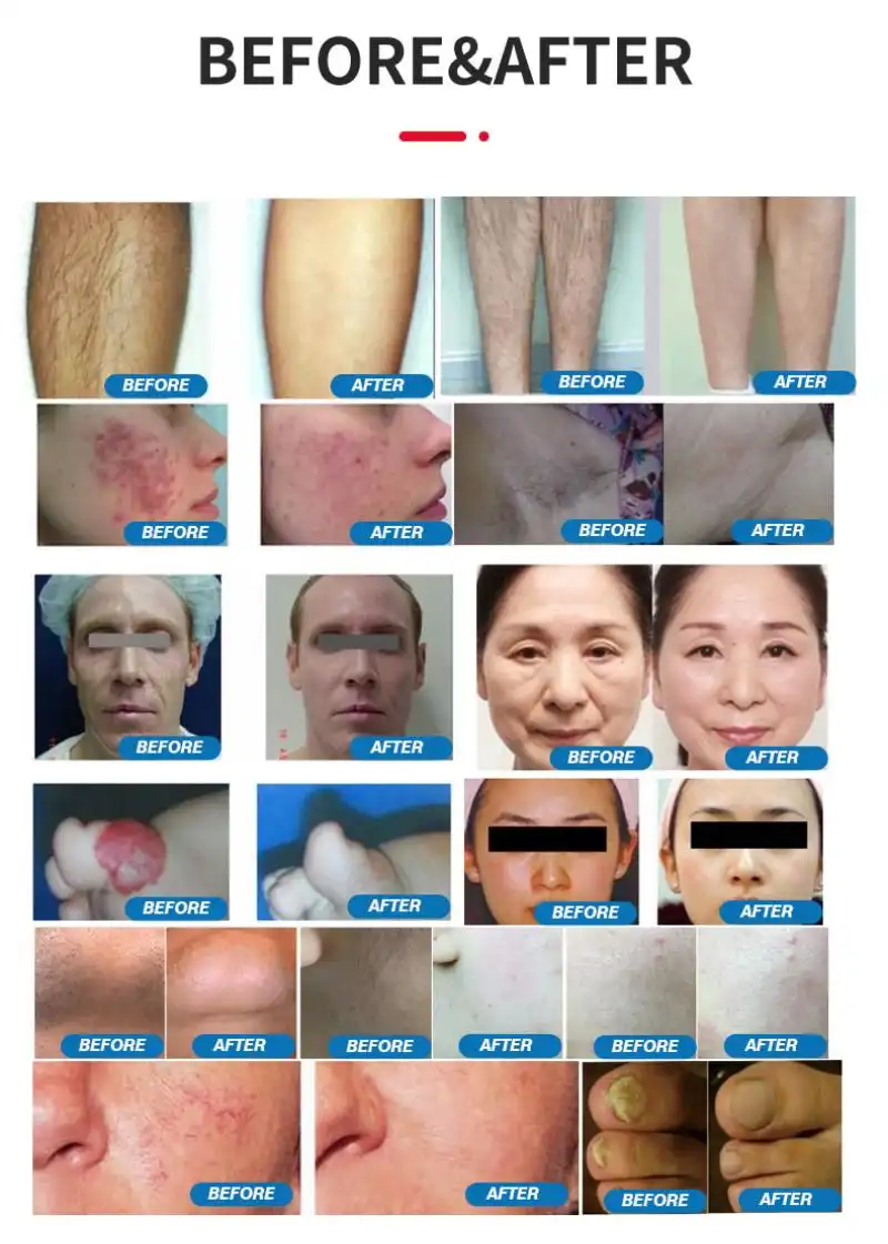 china 1064 nd yag laser hair removal china 1064 nd yag laser hair removal