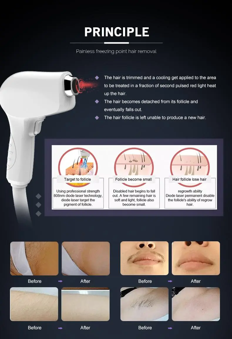 hair removal machine laser factory hair removal machine laser factory