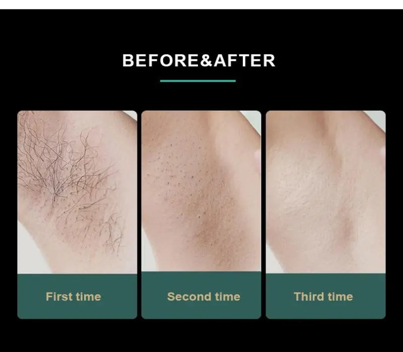 china diode 808 hair removal china diode 808 hair removal