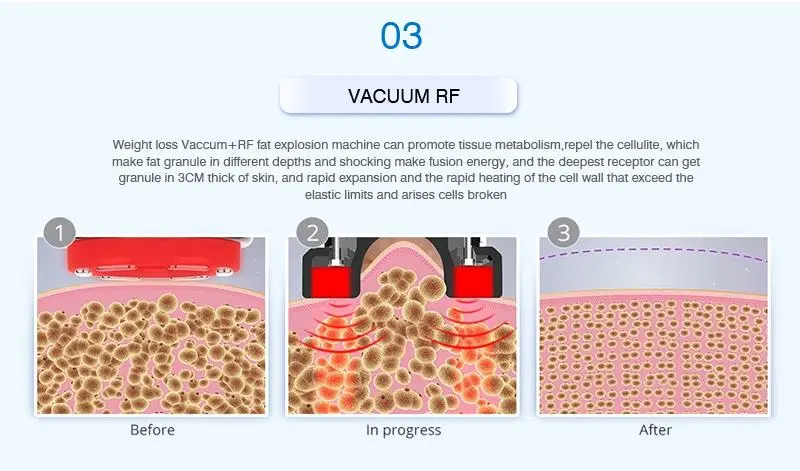 china 40k rf cavitation machine china 40k rf cavitation machine