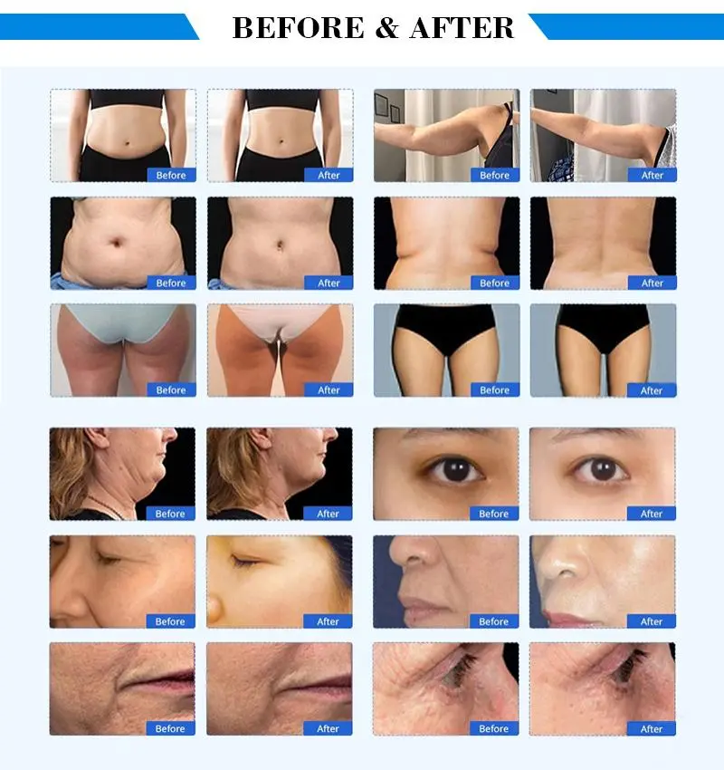 china cavitation machine 40k for sale china cavitation machine 40k for sale