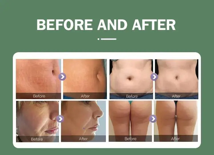 vela slimming machine vela slimming machine