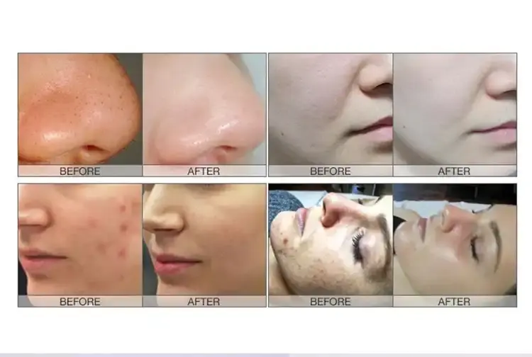 water dermabrasion machine