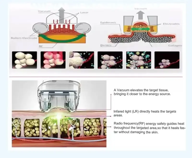 vacuum roller massage machine vacuum roller massage machine