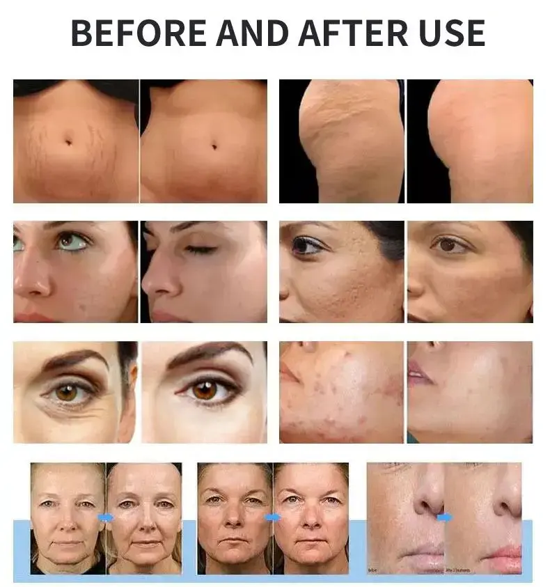 micro needle rf machine