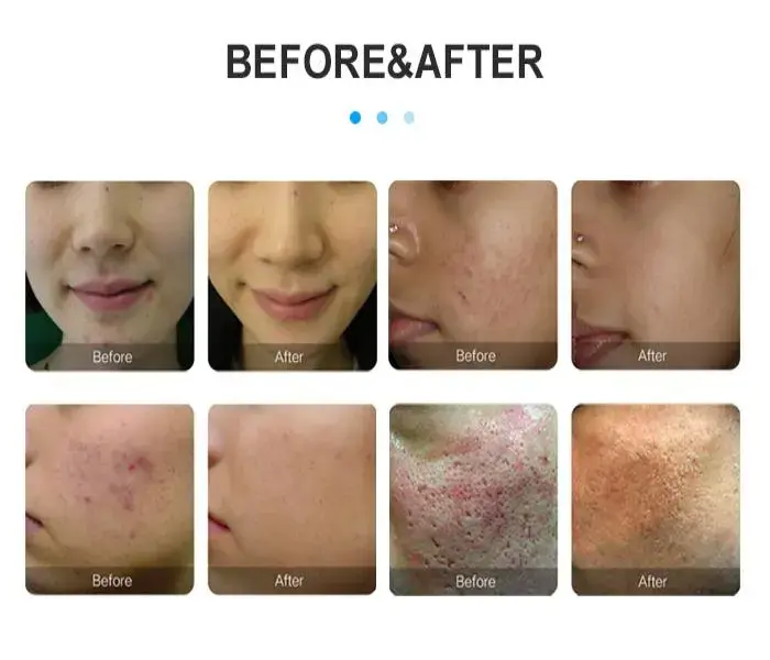 rf microneedling machine rf microneedling machine