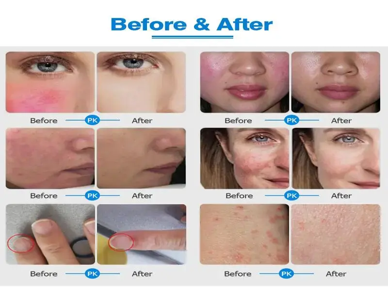 980nm diode laser vascular removal machine 980nm diode laser vascular removal machine