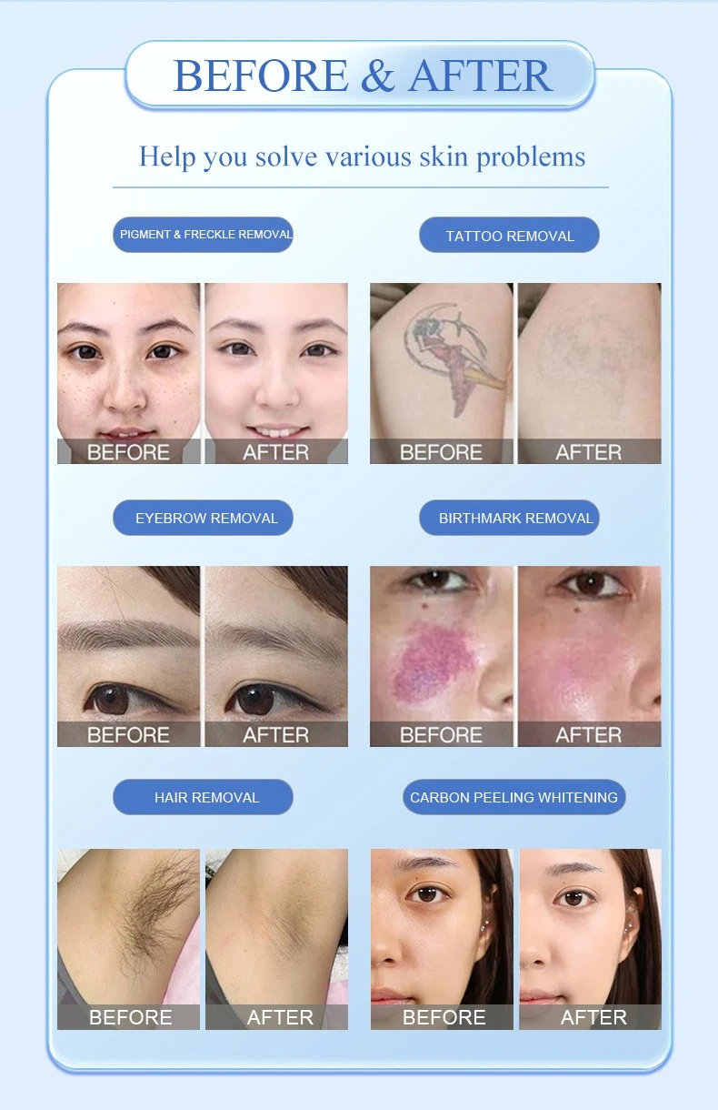 Portable Q switched nd yag laser 1064 nm Portable Q switched nd yag laser 1064 nm