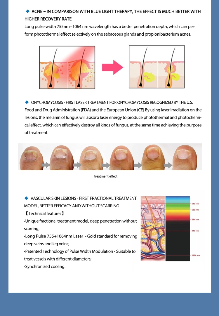 Long Pulse 1064 Laser Long Pulse 1064 Laser