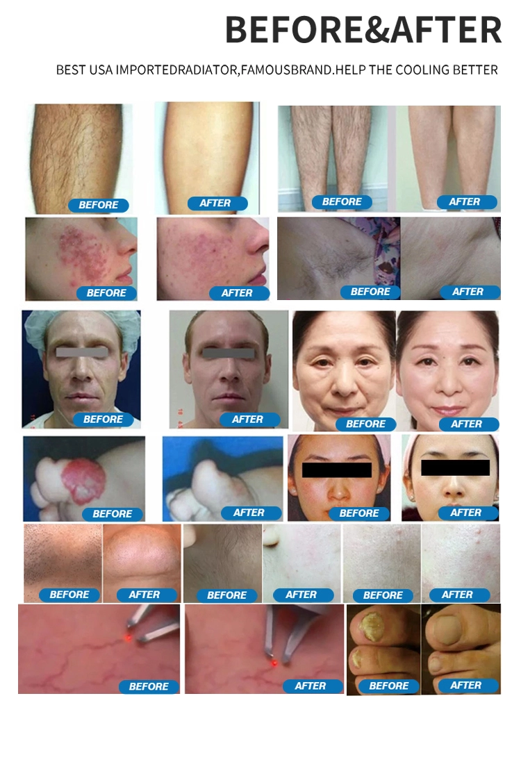 Long Pulse 1064 Laser Long Pulse 1064 Laser