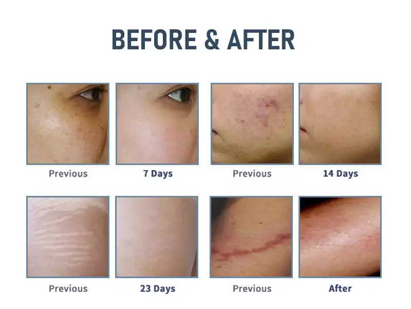 co2 fractional laser machine