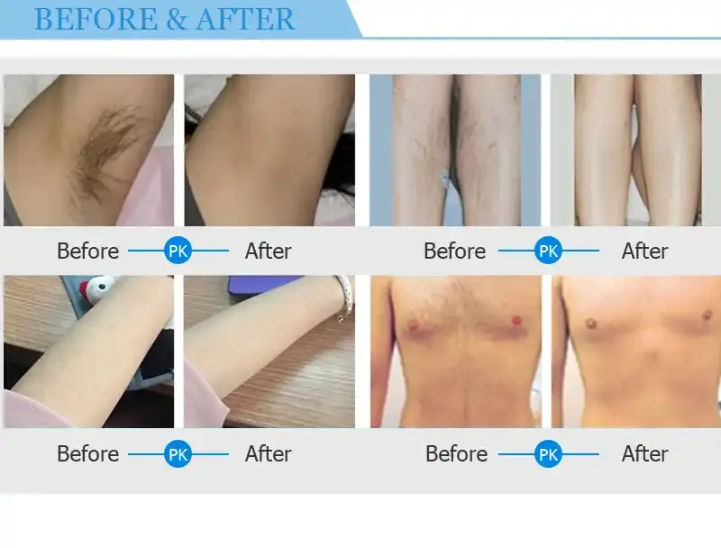 diode 808 laser hair removal machine