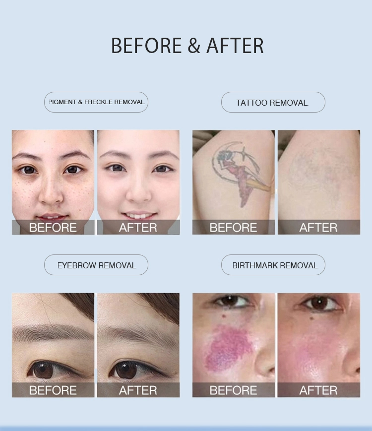 Picotech Q Switched ND YAG Laser