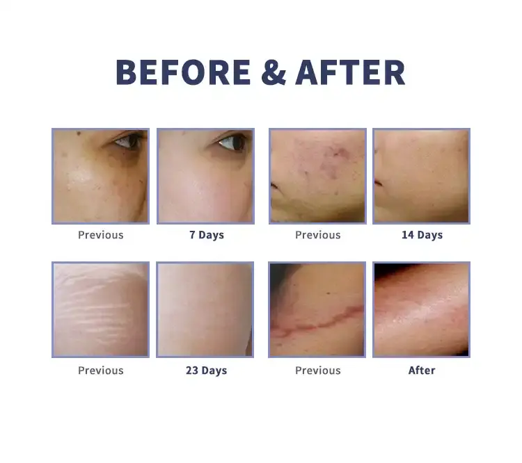 CO2 fractional laser equipment