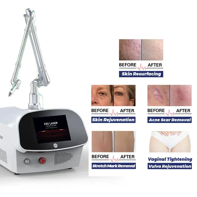 What Are the Benefits of Portable Fractional CO2 Lasers for Beauty Clinics?